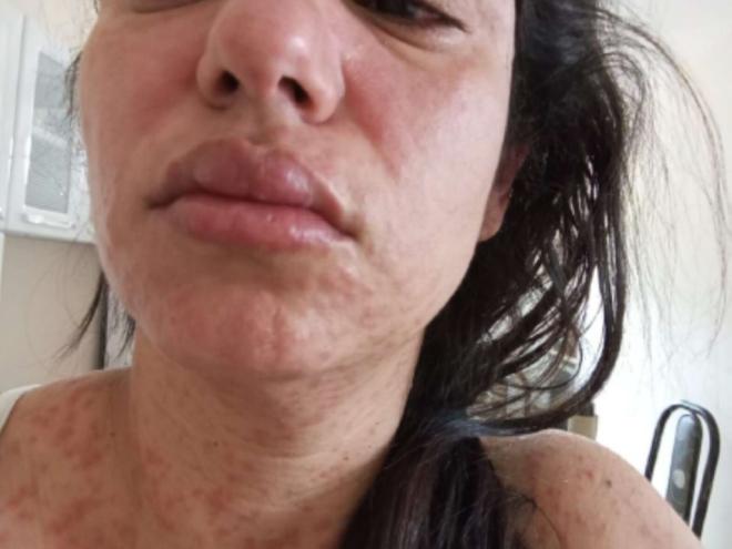 Maraiza sofre com síndrome que provoca erupção cutânea, descamação da pele, bolhas e feridas na boca e nos olhos, dentre outros sintomas
