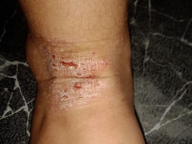 Heitor Miguel sofre com dermatite  atópica grave 