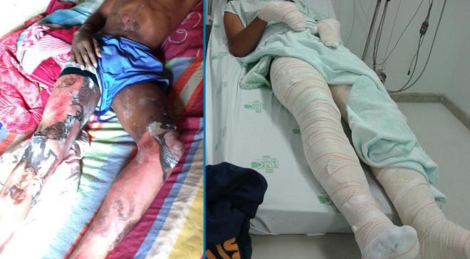 Um adolescente, de 17 anos, foi descoberto pela polícia no hospital e outro, de 16 anos, foi encontrado em casa, também queimado, no alto do bairro Nova Esperança 