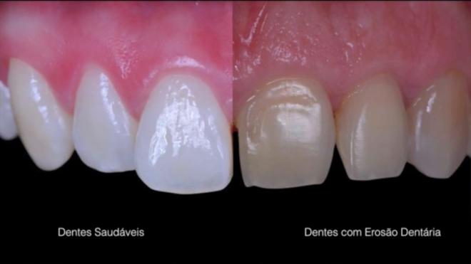 Erosão dentária