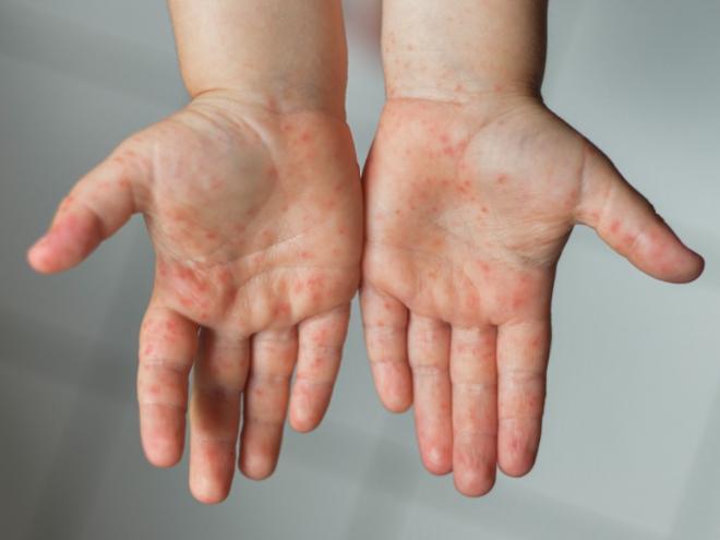 Lesões nas mãos são alguns dos sintomas da doença, que está acometendo crianças da rede pública de ensino da cidade 