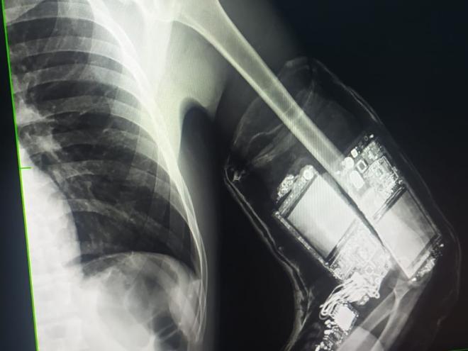 Exame de raios-x mostra celulares escondidos sob o gesso no braço de um preso que havia dado entrada recentemente; até o braço imobilizado era uma farsa 