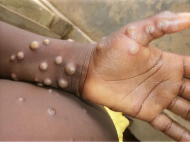 Doença pode provocar lesões na pele, dentre outros sintomas